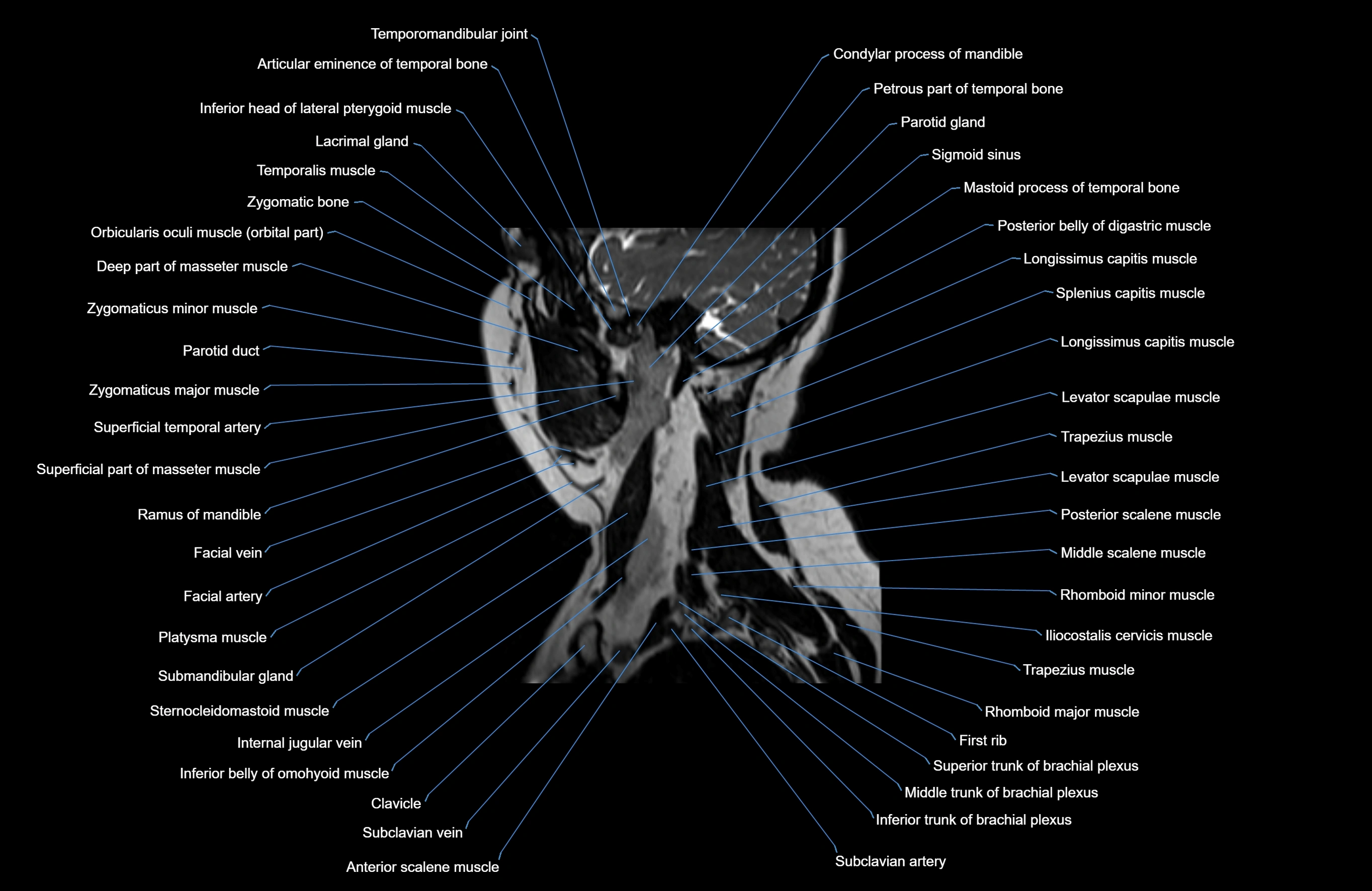 Neck MRI sagittal cross sectional anatomy 3D 1mm 3T radiology  image-img-00001-00028.webp